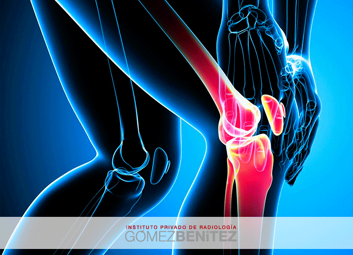 LESIONES DE RODILLA: Cómo fortalecerlas