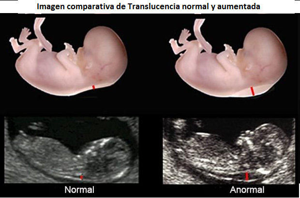 Gómez Benitez - ¿QUÉ ES LA TRANSLUCENCIA NUCAL?