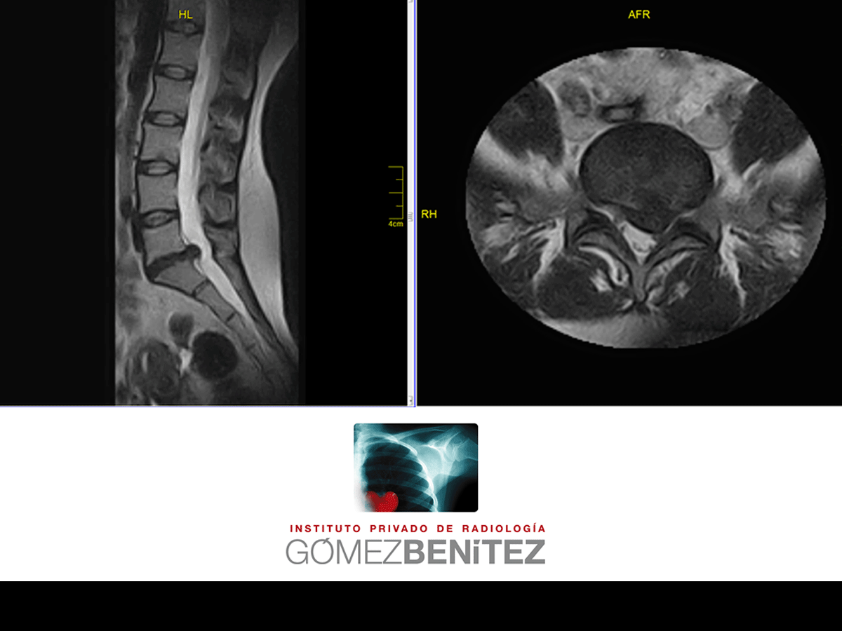 DOLOR LUMBAR: La RMI el mejor procedimiento para diagnosticarlo